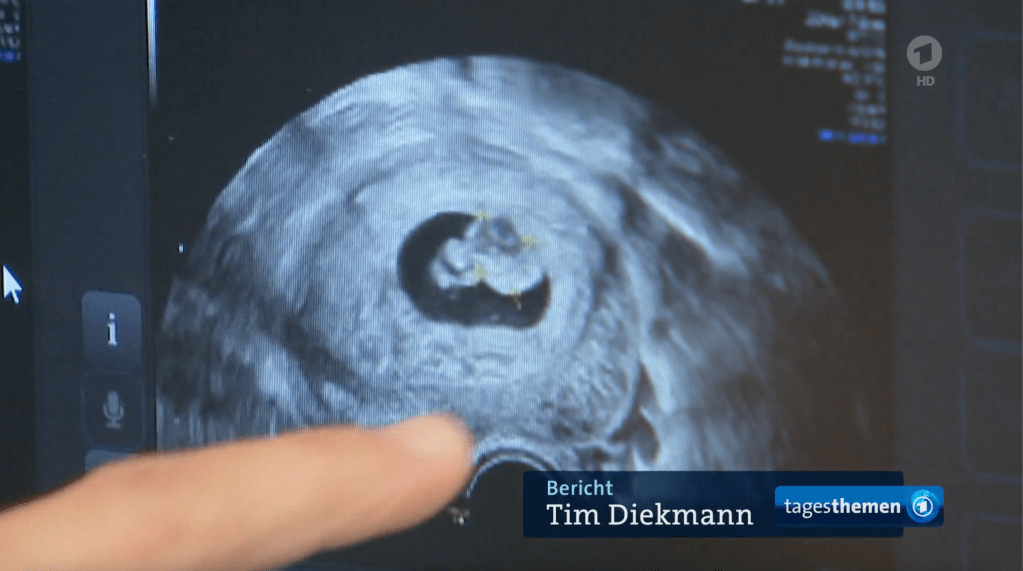 Tagesthemen: Debatte um&nbsp;Abtreibungen